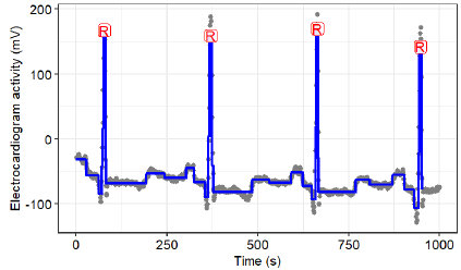 Électrocardiogramme segmenté et pics R détectés